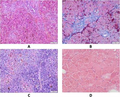 Case Report: Adenosine kinase deficiency diagnosed 10 years after liver transplantation: Novel phenotypic insights